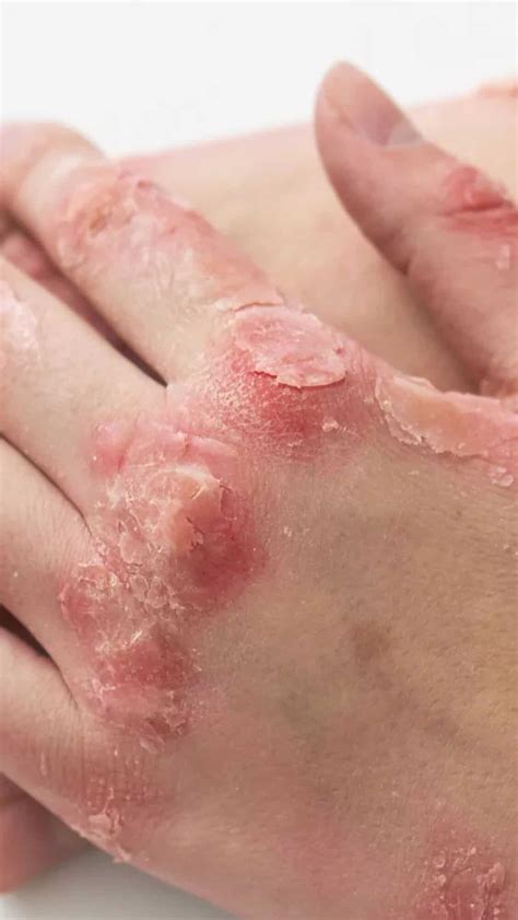 Skin Infection: 5 home remedies to treat scabies