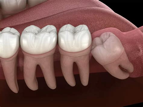 Wisdom Teeth Stitches: Everything You Need to Know - Web DMD