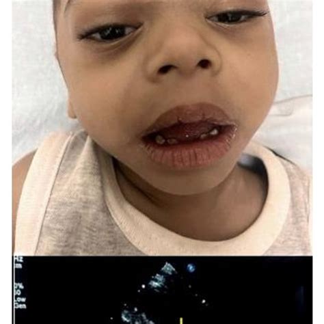 classical elfin facies with 2D echocardiogram (parasternal short axis ...