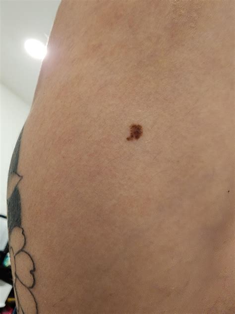 does this look like penile melanosis or melanoma??? : r/Melanoma