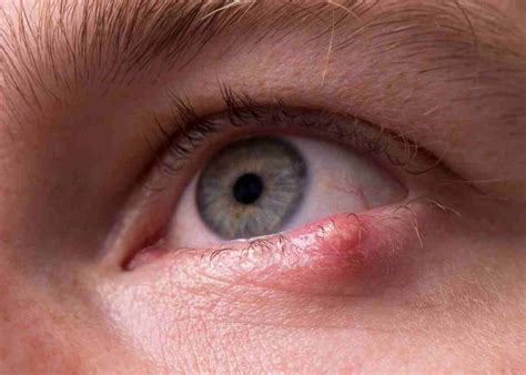 Chalazion | Eyelid Cyst | Chalazion Treatment | Daniel Ezra