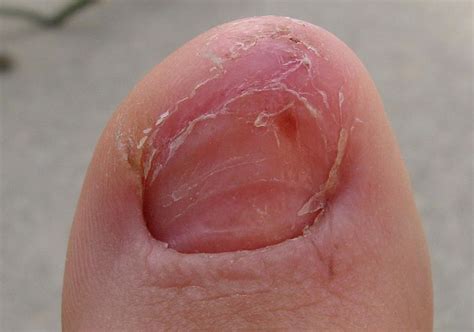 Pictures of Toenail Fungus: Is This What You Have?