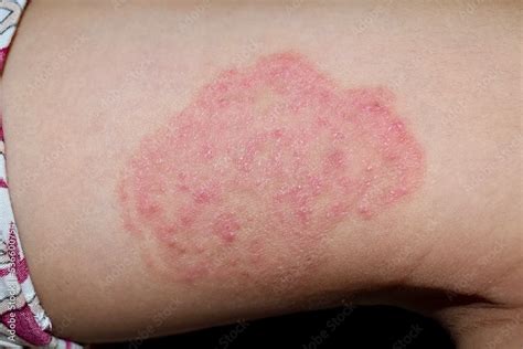 Fungal infection called tinea corporis in thigh of Asian child ...