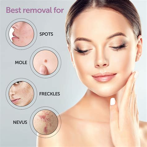 Skin Tags, Moles, Seborrheic Keratosis (Sk) For Northern ... | Skin Tag And Mole Removal ...