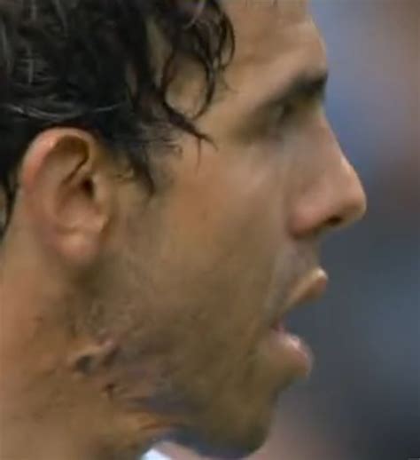 How Carlos Tevez got his Neck Scars - FootyBlog.net