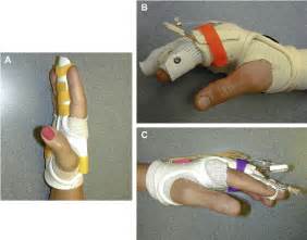 ( A ) Static extension splint; ( B ) dynamic PIP joint extension... | Download Scientific Diagram