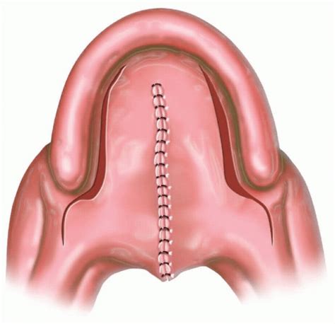 Two-Flap Palatoplasty | Plastic Surgery Key