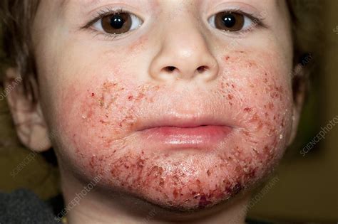 assinatura Lacticínios inseto dermatitis on face em progresso Sorrir segurança