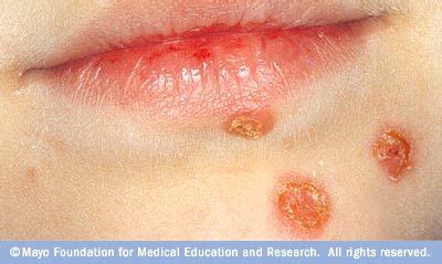 Impetigo | Impetigo, Facial warts, Skin diseases