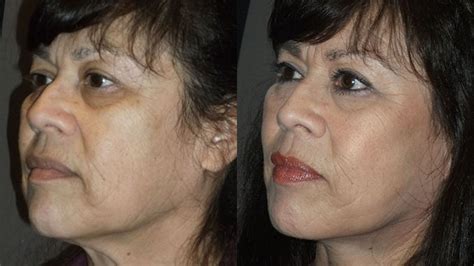 Facelift Inland Empire 19 by Dr. Brian Machida, facial plastic surgeon - LookYounger.News