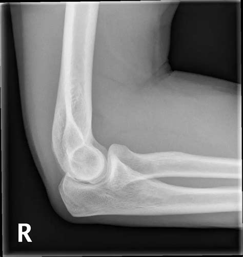 EMRad: Radiologic Approach to the Traumatic Elbow