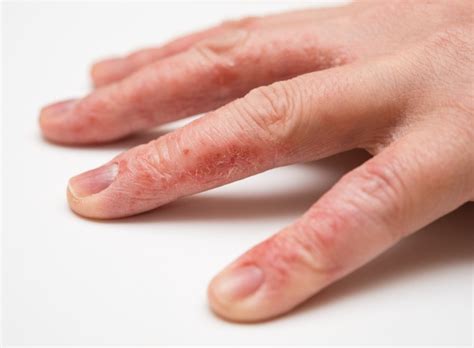 Hand Eczema | Dermatology Associates