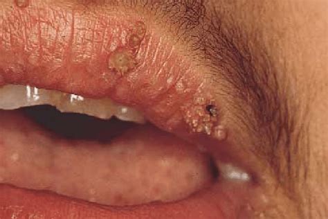 Multiple warts on lips of 6-year-old boy with a kidney transplant; note... | Download Scientific ...