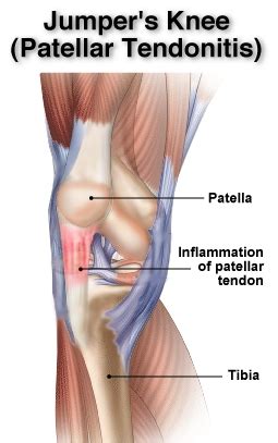 Patellar Tendonitis Exercises / Patellar Tendonitis Prevention