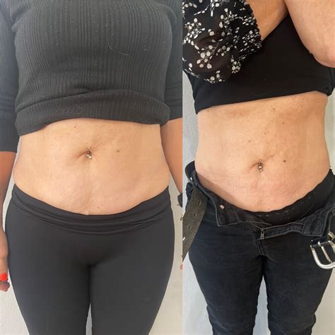 Abdominoplasty-Tummy Tuck Surgery Treatment in Pakistan