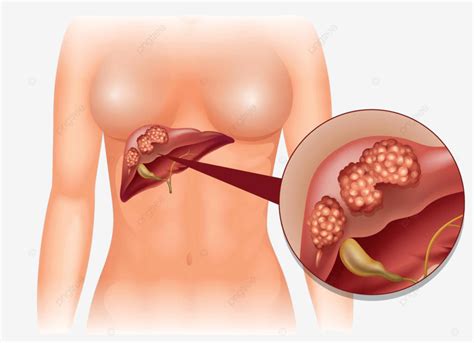 Liver Cancer Diagram In Detail Medicine Close Up Drawing Vector, Medicine, Close Up, Drawing PNG ...