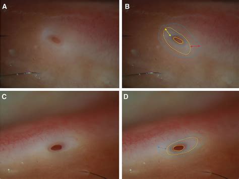 Age-Related Changes in the Lacrimal Punctum Morphology in a ...