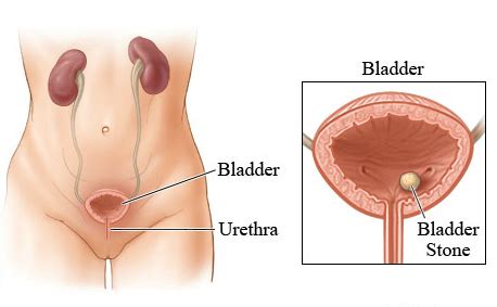 Treatment for Bladder Stones