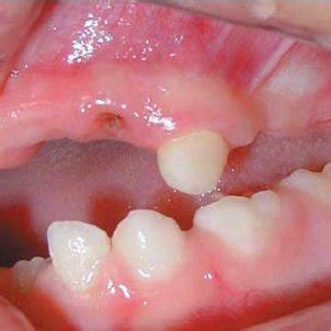 (PDF) Regional odontodysplasia: Case report