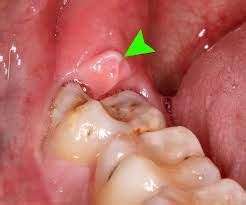 Pericoronitis: Symptoms, Causes, Treatment, and Home Remedies - SmilesCare - Dental education ...