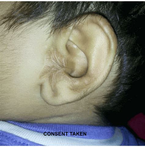 Epidermoid cyst of external auditory canal presenting as canal atresia: A rare case report