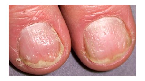 Details more than 141 nail psoriasis topical treatment - ceg.edu.vn