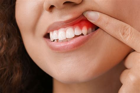 3 Stages of Gum Disease | Dental Practice in Vintage Park Texas