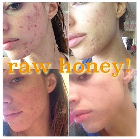 Results from a 100% raw honey face mask every night for 30 minutes for a month...along with ...