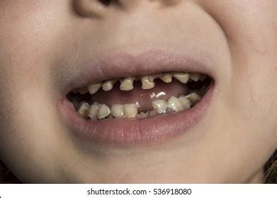 4,547 Rotten tooth 图片、库存照片和矢量图 | Shutterstock