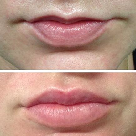 The Basic Principles Of Lip Fillers Comparison: Restylane Vs Juvederm ...