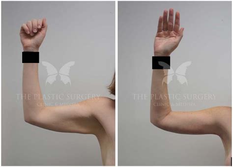 Arm Lift Gallery | Before and Afters | Dr Chaithan Reddy