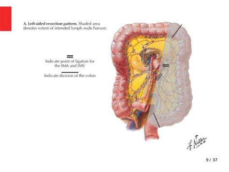 Lt hemicolectomy - Surgical Approach, Complications.