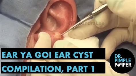 Ear Ya GO! Ear Cyst Compilation Part 2 - Oozy Offerings - Dr. Pimple Popper