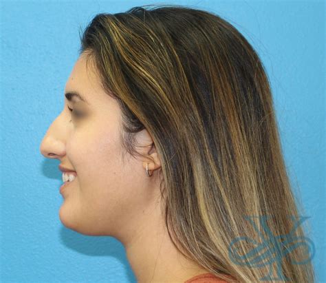 Rhinoplasty Case 3524 - Sara Yegiyants MD FACS