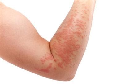 Different skin allergies – causes and treatments | Health24