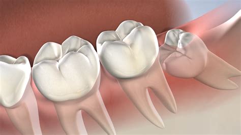 What To Know About Wisdom Tooth Extraction - hanoverorient