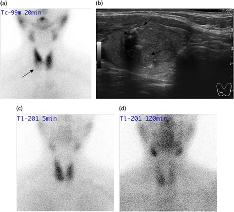 a A Tc-99m scintigraphy image showing a cold thyroid nodule (arrow) in... | Download Scientific ...