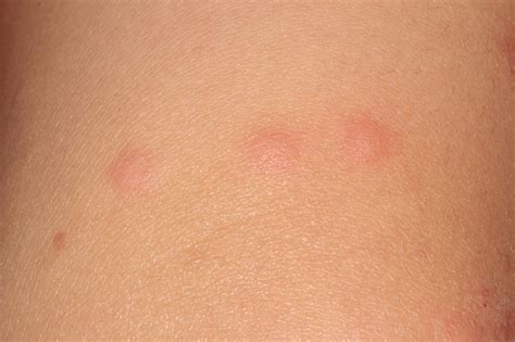 How To Diagnose Bed Bug Bites / Chigger Bites Vs Bed Bug Bites Telling Them Apart / However ...