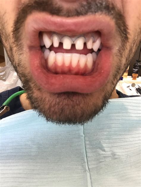 Shaved teeth pre-veneers : r/oddlyterrifying