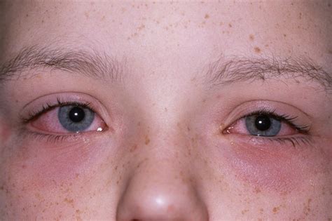 Dust Mite Allergy and Skin Rash (Dust Allergy Rash) | 9 Tips For Eczema