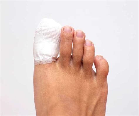 Toenail Removal: Everything You Need To Know