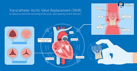 Aortic Valve Replacement: Purpose, Preparation, Procedure & Risks