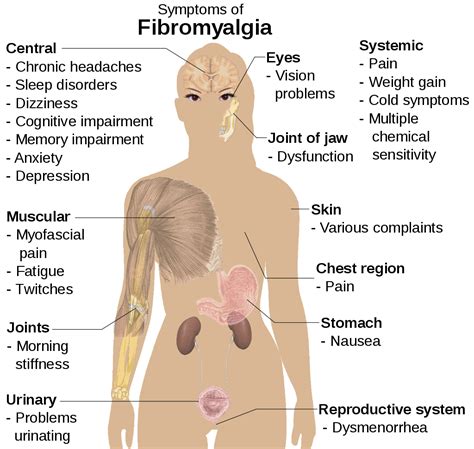 Fibromyalgia: Diagnostic Criteria and the Danger of Misdiagnosis ...