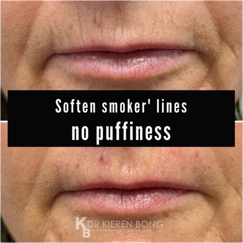 Soften smoker’s lines with dermal filler