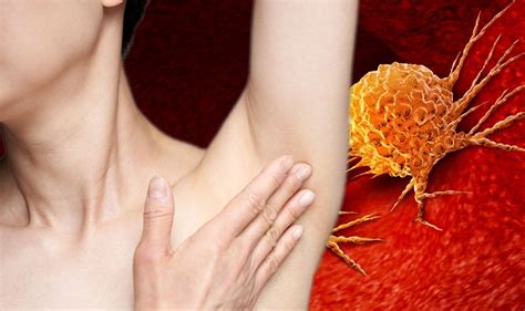 Cancer: Symptoms of skin cancer may include lumps under the armpit | Express.co.uk