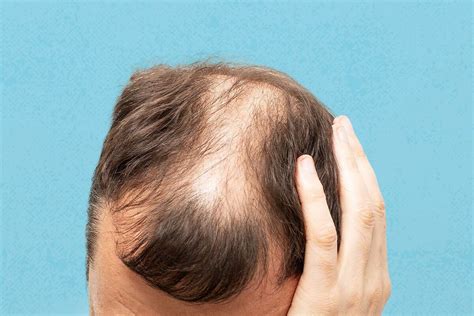 Cara Mengatasi Rambut Rontok Pria Secara Alami, Bisa Ditemukan di Halaman Rumah