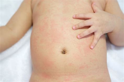 My Toddler has an Itchy, red, Scaly Rash Around the Belly Button. What Could it Be? - Nabta Health