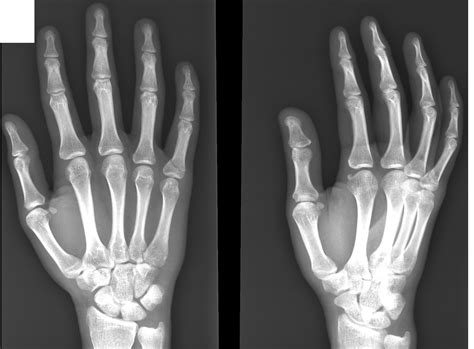 Hand x-ray. Causes, symptoms, treatment Hand x-ray