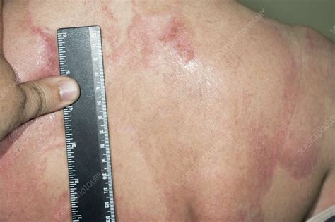 Psoriasis on the back during treatment - Stock Image - C010/3367 ...