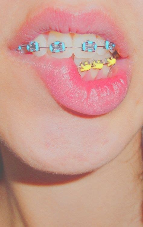 Braces Colors For Girls Teeth - Photos Cantik